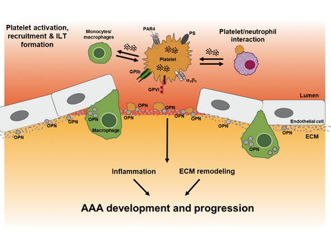 Grafische Darstellung des Prozesses: Abdominelle Aortenaneurysmen (AAA) sind durch eine chronische Entzündung, fortschreitenden Umbau der extrazellulären Matrix und zunehmende Gefäßwandsteifigkeit gekennzeichnet. Thrombozyten nehmen eine aktive und funktionell relevante Rolle in der Thromboinflammation während der AAA-Pathogenese ein, was sowohl in humanem AAA-Gewebe als auch in etablierten experimentellen Mausmodellen nachgewiesen werden konnte. Aktivierte, prokoagulante Thrombozyten interagieren dabei direkt mit zirkulierenden Zellen (insbesondere Monozyten und Neutrophile), sowie mit residenten Zellen (Fibroblasten und glatten Muskelzellen) und eingewanderten Makrophagen. Diese zellulären Interaktionen fördern Adhäsion und Migration von Thrombozyten in die abdominale Aortenwand und begünstigen das Wachstum des intraluminalen Thrombus (ILT). Parallel hierzu verstärken Thrombozyten-vermittelte Signalprozesse die lokale inflammatorische Antwort, induzieren die Expression matrixabbauender Enzyme (u. a. MMP9) und fördern strukturelle Degenerationsprozesse in der Gefäßwand. Diese umfassen unter anderem die Fragmentierung elastischer Fasern, sowie eine weitere Zunahme der Gefäßwandsteifigkeit und tragen damit wesentlich zur Progression und Destabilisierung des AAA bei.
