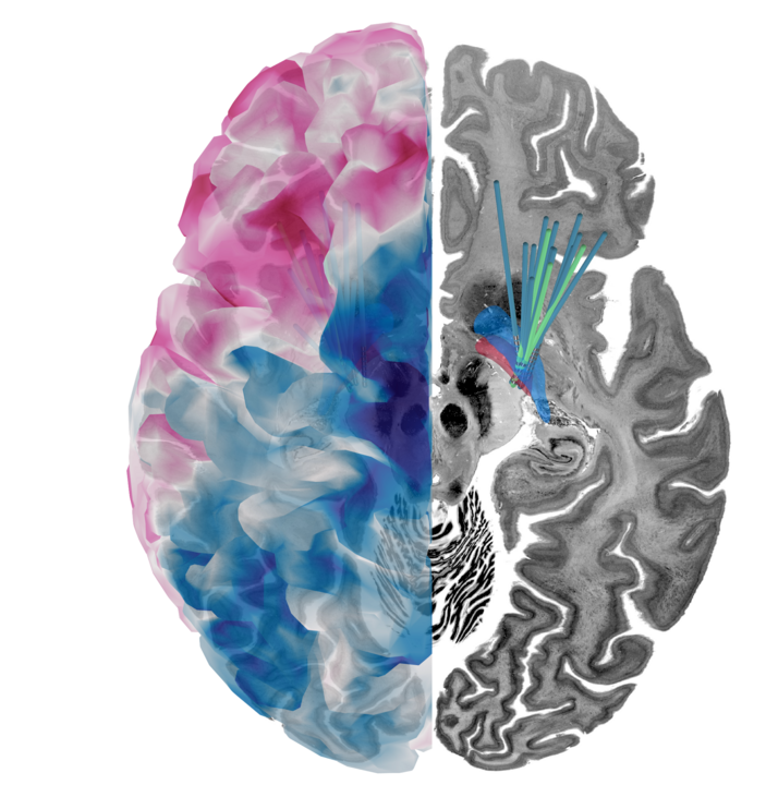 Ansicht eines Gehirns mit sichtbarer niederfrequenter Hirnaktivität
