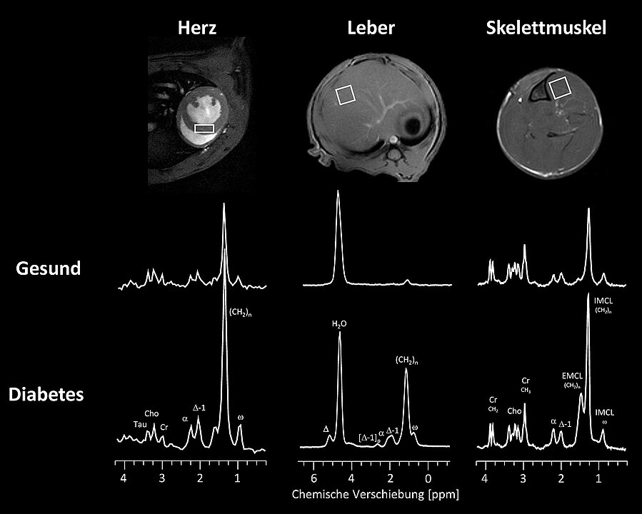 MRT-Vergleichsaufnahmen von drei Organen, die Auswirkungen einer sich entwickelnden Diabetes durch Anstieg der Fettablagerung zeigen.